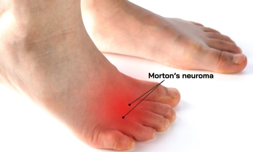 What Causes Morton's Neuroma