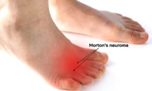 What Causes Morton's Neuroma