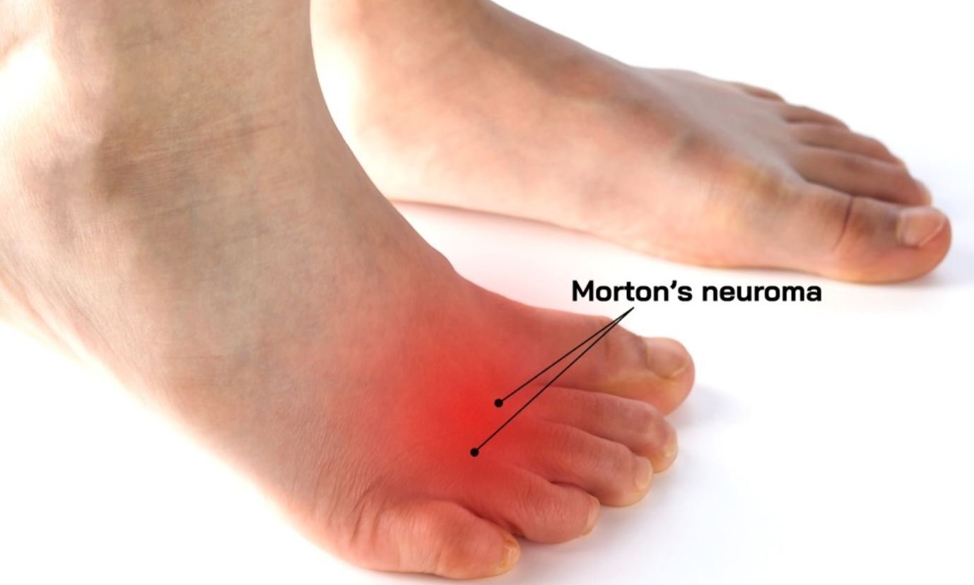 What Causes Morton's Neuroma