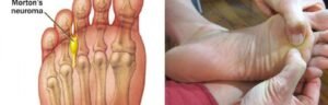 What's Morton's Neuroma
