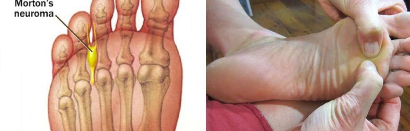 What's Morton's Neuroma