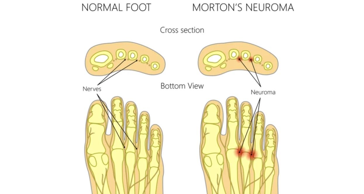 What Does Morton’s Neuroma Look Like