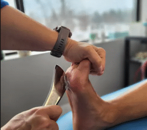 What is the Prognosis for Morton's Neuroma? Recovery Insights