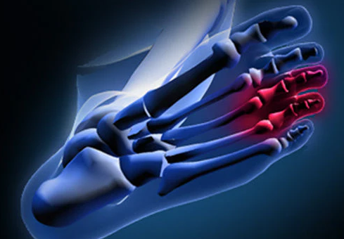 What is Morton's Neuroma of the Foot? Anatomy Explained