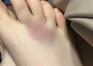 Does Morton's Neuroma Cause Bruising? What to Look For