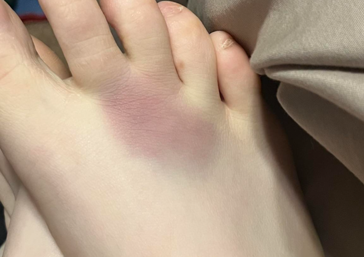 Does Morton's Neuroma Cause Bruising? What to Look For