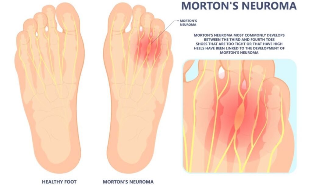 Does Morton's Neuroma Cause Numbness.