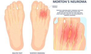Does Morton's Neuroma Cause Numbness.