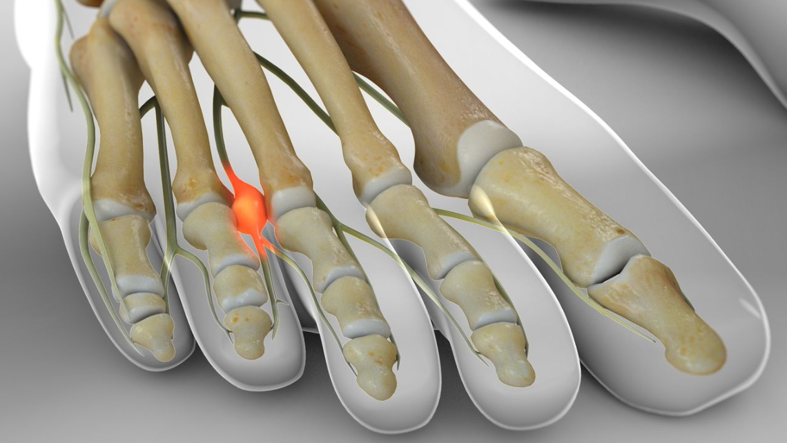 What Triggers Morton's Neuroma Pain? Common Aggravators