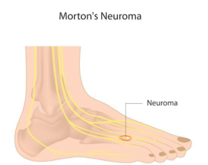 Why Does Morton's Neuroma Hurt at Night? Pain Patterns