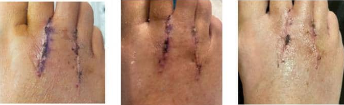 How Painful is Morton's Neuroma Surgery? Recovery Explained