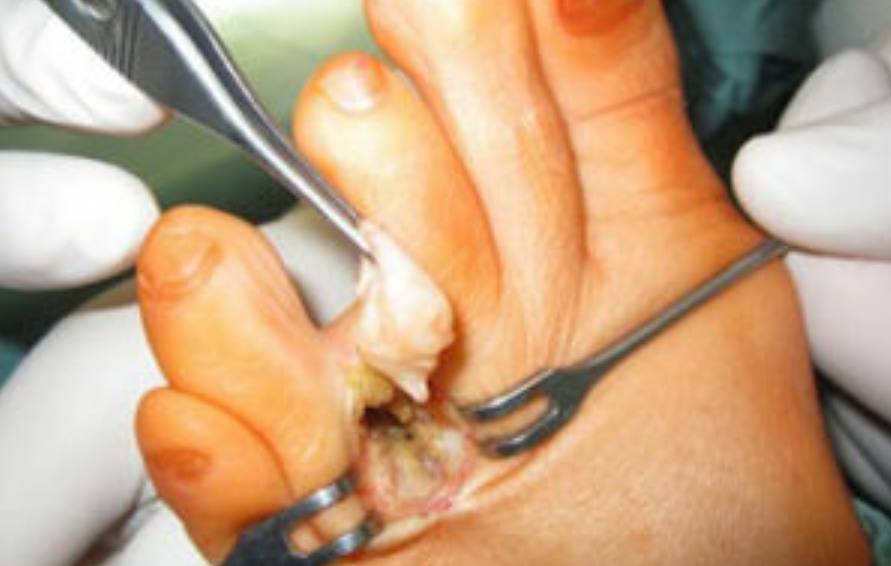 What is Morton's Neuroma Surgery? Types and Procedures