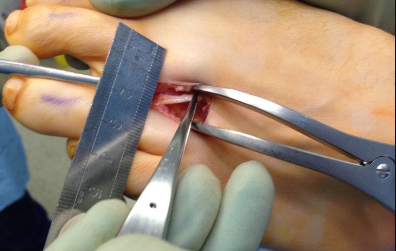 When is Surgery Needed for Morton's Neuroma? Key Indicators