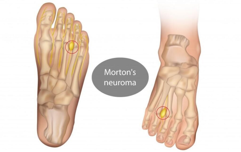 Can Morton's Neuroma Return After Surgery.