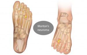 Can Morton's Neuroma Return After Surgery.