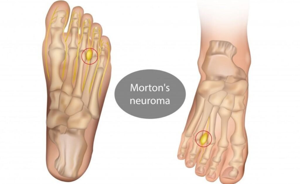 Is Morton's Neuroma Surgery Worth It