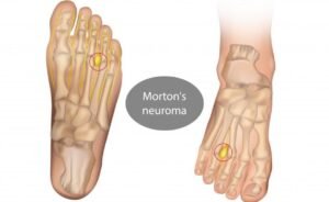 Is Morton's Neuroma Surgery Worth It