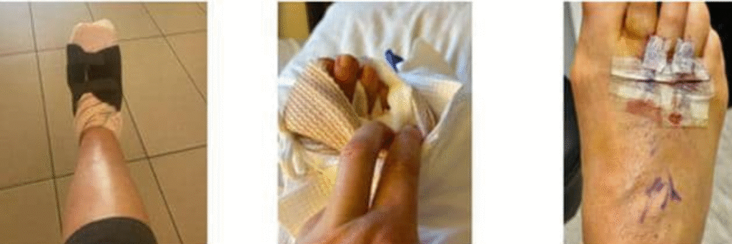 What to Expect After Morton's Neuroma Surgery: Recovery Tips