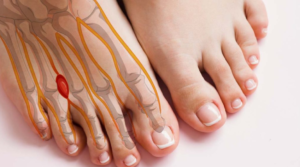 Can Reflexology Help Morton's Neuroma? What to Know