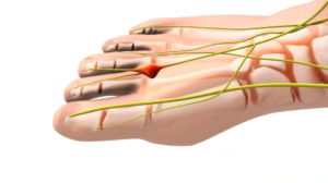 How to Relieve Morton's Neuroma Pain: Top Tips